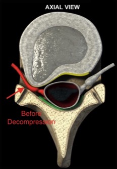 before-spinal-decompression