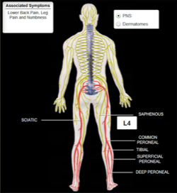 Lumar-Radiculopathy