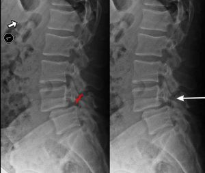 Pars-Defect-xrays-movement