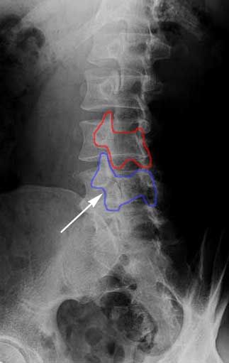 Pars-Defect-xrays