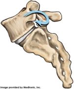 spondylolisthesis-Fracture